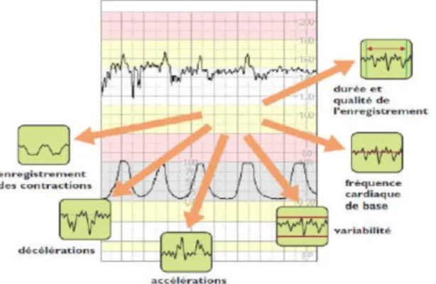 Figure 1.11 : Tracé du rythme cardiaque fœtal à partir d’un CTG [23]. 