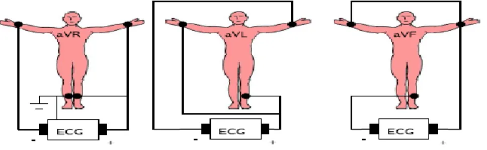 Figure I.8. Montage de Goldberger pour l'enregistrement des dérivations unipolaires des  membres augmentés [19]