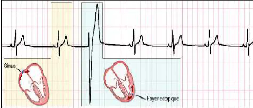 Figure 1.35.Extrasystole Ventriculaire(ESV) [6].