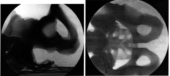 Figure  2-1:  Lateral  and  AP  acquisitions  of  X-ray  fluoroscopic  images  of  the  pelvis phantom.