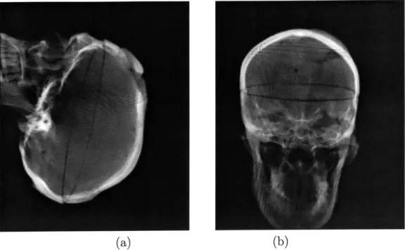 Figure  2-4:  CT-derived  DRR  images  produced  by  the  voxel-projection  algorithm The  main  idea  behind  the  latter  comes  from  the  field  of  computer  graphics,  and is  referred  to  as  view-based  rendering