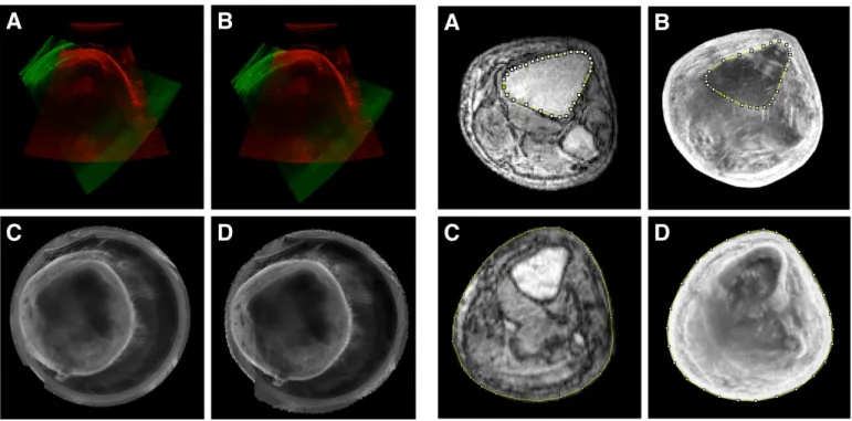 Fig. 7. Demonstration of motion compensation based on 3D camera tracking. (A) Two overlaid ultrasound images, shown in red and green, collected at different circumferential positions