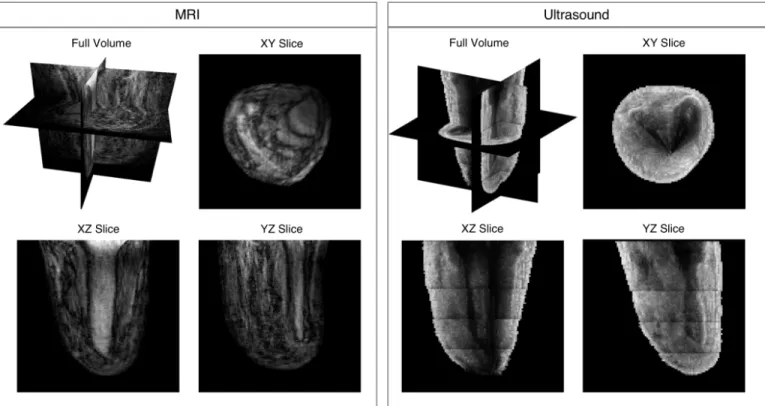 Fig. 9. Volume ultrasound imaging results (left) for one amputee subject with associated MRI (right)