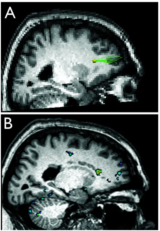 Figure 1. Structural and functional connectivity of periventricular heterotopia to overlying cerebral cortex