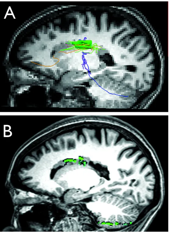 Figure 2. Structural and functional connectivity of periventricular heterotopia to cerebellum Diffusion tensor tractography results co-registered on T1-weighted sagittal anatomical MR image (A) show fiber tracks (blue) extending from a large, confluent reg