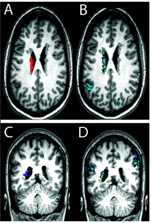 Figure 3. Functional connectivity of periventricular heterotopia to ipsilateral and contralateral cortical regions