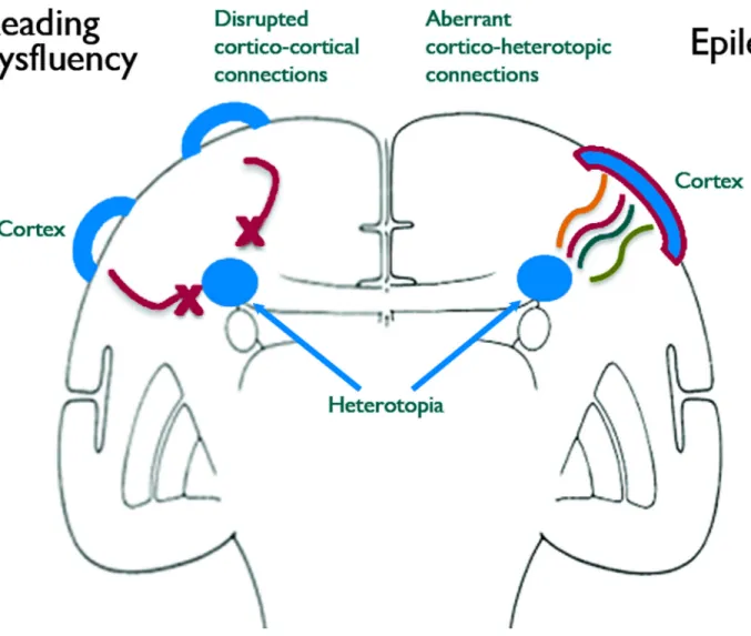 Figure 4. A connectivity model of neurological dysfunction in gray matter heterotopia