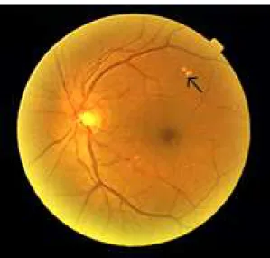 Fig. 2. Original retinal image: The hard exudates (the bright patches) will be two spots on the processed image