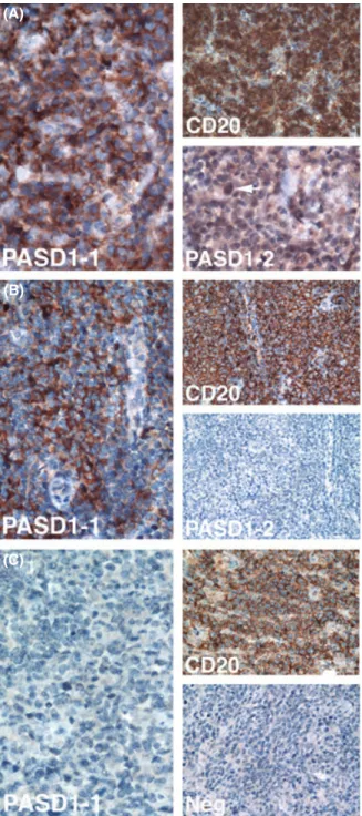 Fig 4. Immunoperoxidase labelling studies of biopsy sections from patients with de novo DLBCL