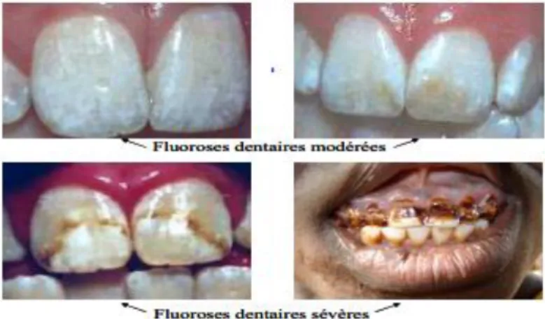 Figure I.5 : Cas de fluoroses dentaires 
