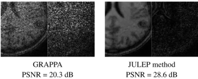 Fig. 2. The inset images and difference images above sug- sug-gest that while the GRAPPA reconstruction is very noisy, the JULEP joint estimated image has much less noise.
