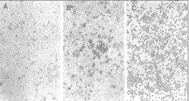Figure  5.  Effet  cytopathique  (ECP)  caractéristique  des  virus  coxsackie  B sur  des  cellules  rénales  d’un singe africain (Menegus et Hollick, 1982)