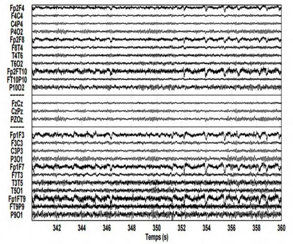 Figure 1-6: Exemple d’un enregistrement d’EEG Normal 