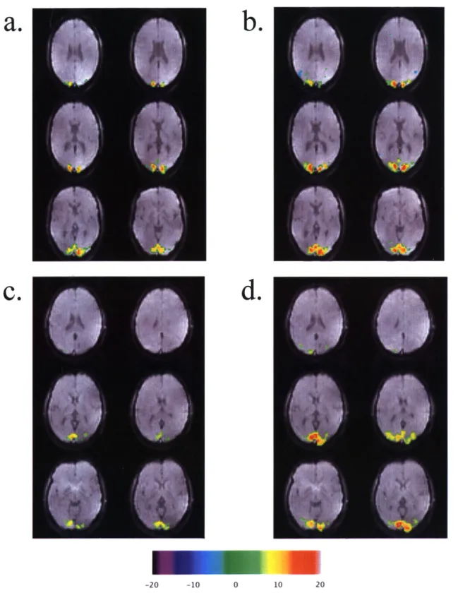 FIG  6.  Comparison  of visual  cortex  functional  activation  maps  acquired  with  default  ASL parameters  TI 1  =  700  ms,  TI 2  =  1400  ms,  and  tag width  =  100  mm  (a:  subject  8,  c:  subject  9) and  optimized  ASL  parameters  TI,  =  100