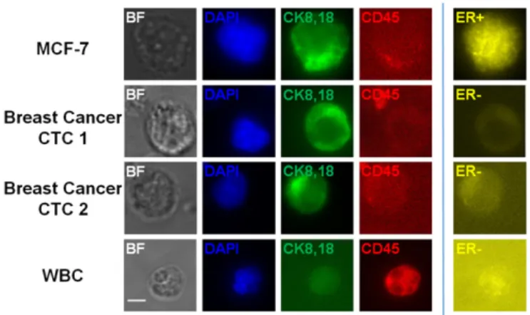 Fig. 6. Immunofluorescence images for the identification of CTCs in blood samples from breast cancer patients