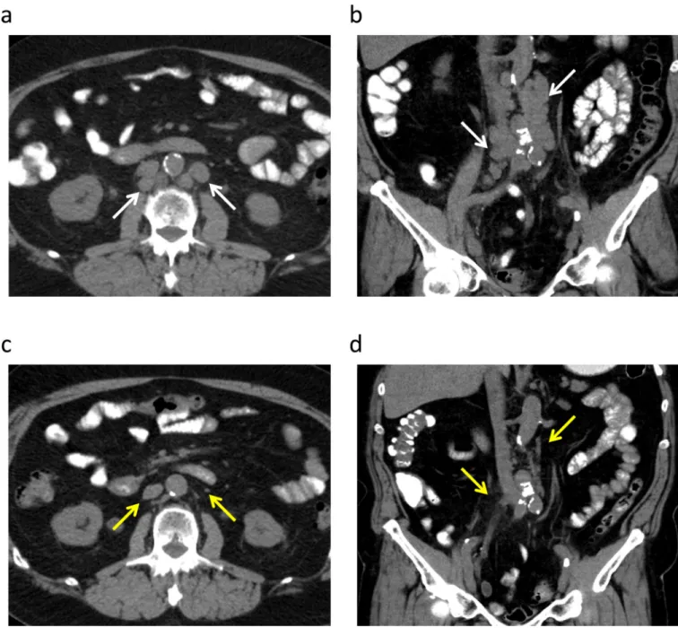 Figure 1. A 70 year-old man with metastatic urothelial carcinoma with a 14-month complete response to everolimus and pazopanib