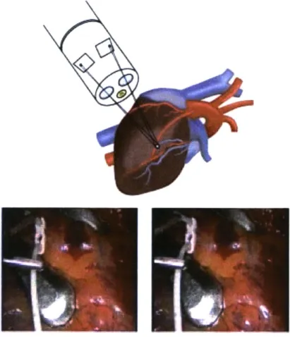Figure  1.3:  Schematic  of  a stereo-laparoscope  observing the heart and in vivo stereo pair obtained  f-om  such an observation