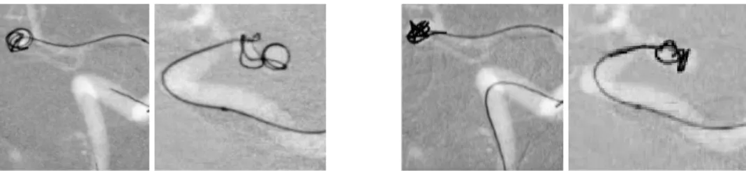 Figure 5. Examples of our simulation results: (left) real coil embolization; (right) our simulated coil embolization with 3D coils.