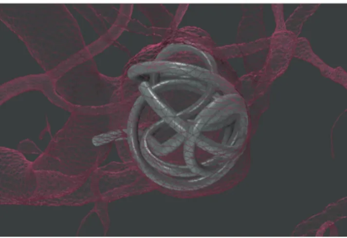 Figure 9. The shape of detachable coils after deployment.