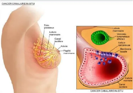 Figure 07 : Cancer Canalaire In Situ (Maisonnette et al., 2010) 