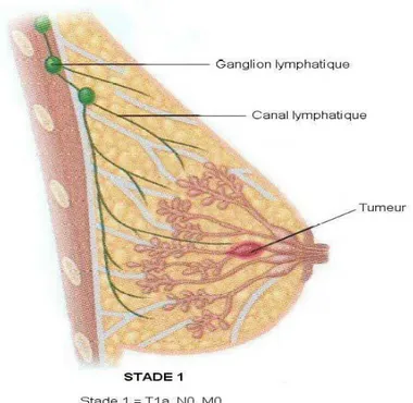 Figure 5 : Stades 1 du cancer du sein (Singletary SE et al ,2003). 