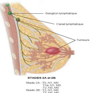 Figure 6 : stades 2 du cancer du sein (Singletary SE et al ,2003). 