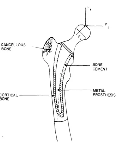 Figure  2.16:  Femoral Component  of Total  Hip  Replacement  and Applied  Joint  Force  Components.