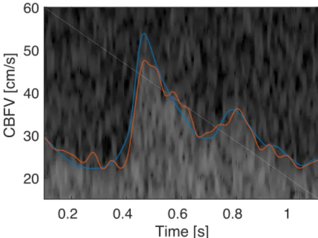FIGURE 11. This figure shows the difficulty of finding a maximal blood flow velocity in low SNR spectrograms