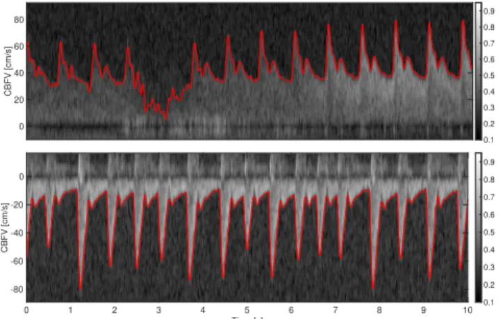 FIGURE 1. Top: Doppler spectrogram obtained by insonating the M1 segment of the middle cerebral artery