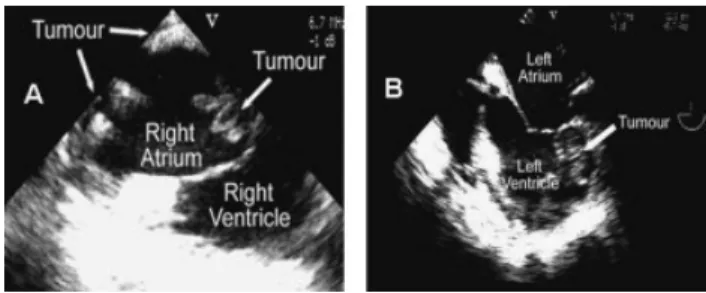 Fig. 1. Trans-esophageal echocardiography showing myocardial tumor involvement of right atrium (A) and left ventricle (B).