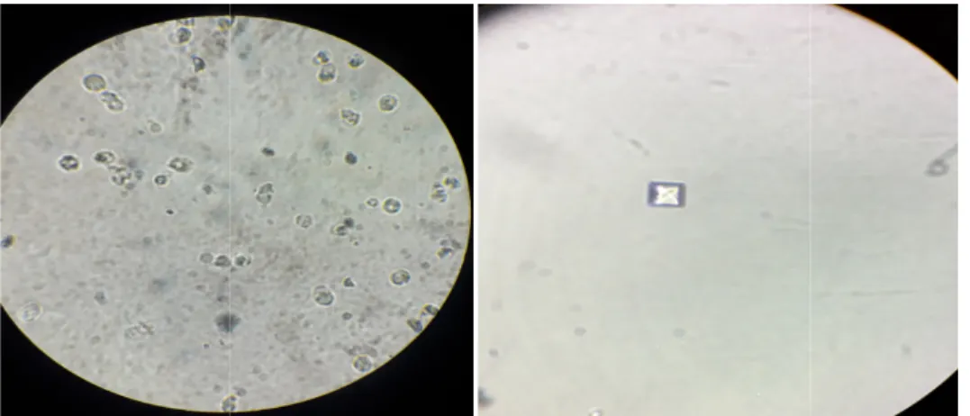 Figure 10 : Observation des urines à l’état frais sous microscope optiques (G×40)                a: Leucocytes x 40