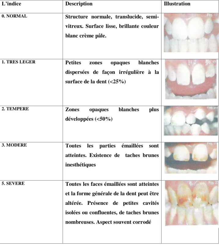 Figure I.1 : Classification  de fluorose dentaire (Dean modifiée ) [21].