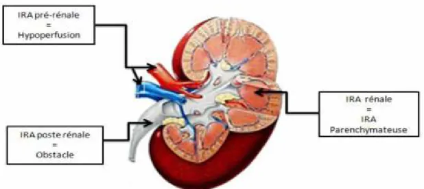 Figure  03: Localisation  des  causes  éventuelles  de  l’insuffisance  rénale aigue.