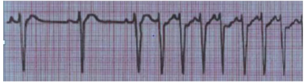 Figure I.12. Tachycardie supra-ventriculaire [14]. 