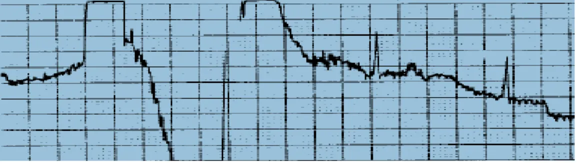 Figure I. 17. Les bruits dus au mauvais contact électrode-peau [16]. 
