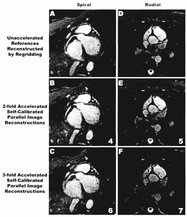 FIGURE 2.6 2x and 3x Spiral and Radial Parallel Image Reconstructions