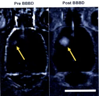 Figure  2-6:  Contrast-enhanced  Tl-weighted  magnetic  resonance  images  of  the  rat  brain before  (left) and  after  (right) ultrasound-induced  BBB  disruption around  the tumor  (arrows) showed  increased  penetration  of MR  contrast agent  through