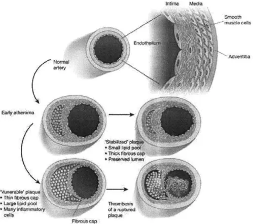 Figure 1.1  Illustration of the plaque  formation process.  The evolution of the lesion is a  silent process.