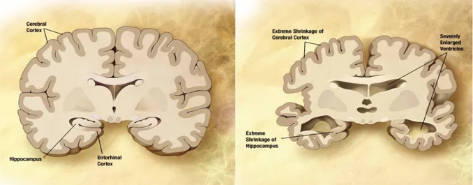 Figure 01 : Comparaison entre un cerveau d’un sujet sain et d’un malade d’Alzheimer (Alice,  2016)