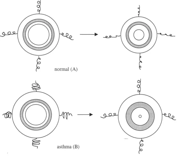 Figure 1.2b:  Hyperresponsiveness  due  to increased  adventital  thickness.  Thicker adventitia reduces  load on smooth  muscle by  the  parenchyma,  (depicted  as  unloaded springs  in B), resulting  in greater  smooth muscle  constriction  upon activati