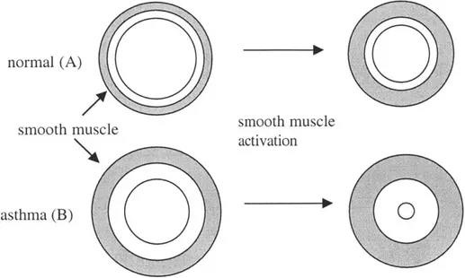 Figure  1.2c:  Hyperresponsiveness  due  to  increased  smooth  muscle  mass.  Thickened smooth  muscle  is  able to  generate  more  force,  and  cause  greater  airway  obstruction  (B)