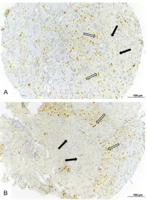Figure  3 shows representative examples of  TNBCs with different expressions of Zeb1 in  tumor and stromal cells and the corresponding  patterns  of  CD8+  TIL  infiltration  revealed  by  single IHC labeling.
