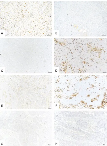 Figure 3. Representative examples of Zeb1 expression by tumor or stromal  cells and infiltration by CD8+ TILs in triple negative breast cancer (single IHC  labeling)