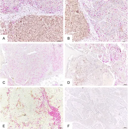 Figure 4. Representative images of spatial relationship between tumor or  stromal Zeb1+ cells and CD8+ TILs in triple negative breast cancers (double  IHC labeling; brown, Zeb1; purple, CD8)