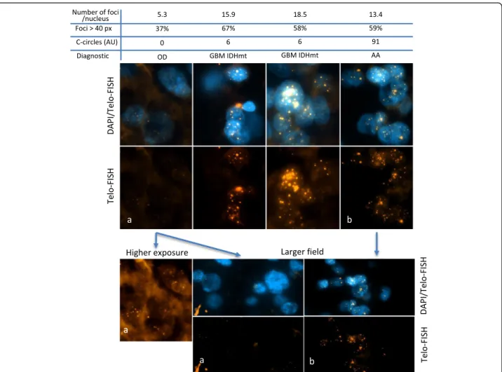 Fig. 3 Detection of ultra-bright telomeric foci by Telo-FISH in paraffin-embedded sections of tumors, together with detection of DNA by DAPI in the same section, as indicated (40X magnification)