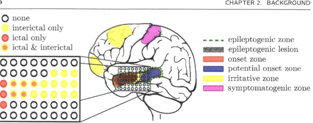 Figure  2.1:  In  iEEG,  electrode  arrays  and  strips  are  placed  over  a limited  area of  the cortical  surface  that  is  suspected  to  contain  the  onset  zone