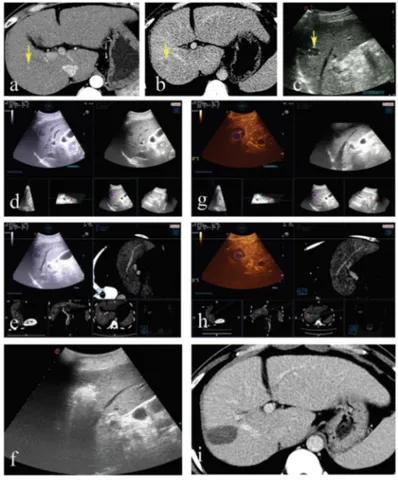 Figure 3. A 51-year-old male. (a,b) Contrast-enhanced computed tomography (CT) indicates a liver  tumor  located  in  segment  7