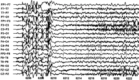 Figure  2-9:  A  second  seizure  within the  scalp  EEG  of Patient which  begins  at 6210  seconds,  resembles  the  seizure  shown  in