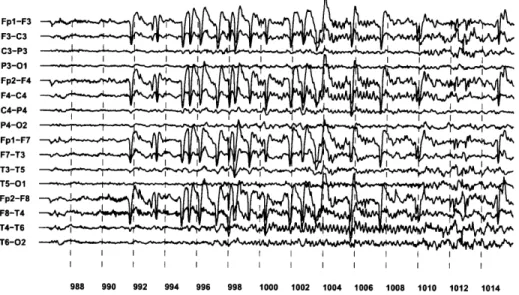 Figure  2-12:  Example  of  a  seizure  recorded  from Patient  C  approximately  10  months after  recording  the  seizure  in  Figure  2-11.