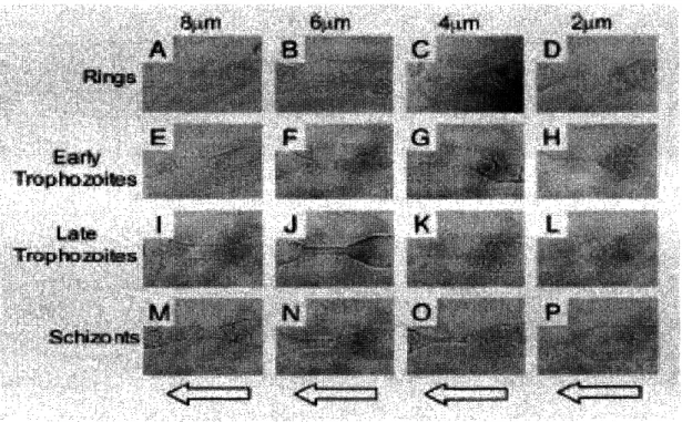 Figure 3 Microscopic  image  illustrate iRBCs  induced channel blockage  at different stages for different channel dimensions  [6]